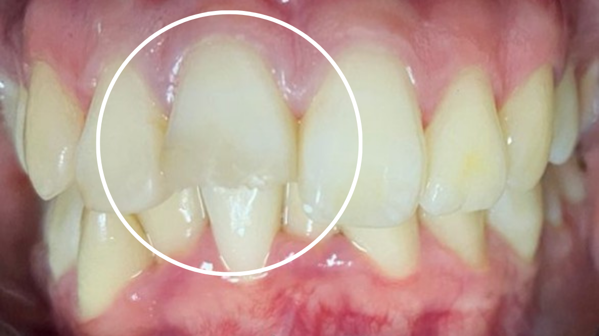 Caries — Antes