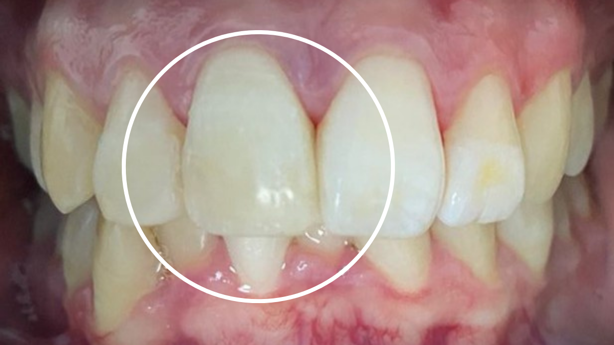 Caries — Después