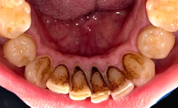 Limpieza dental — Antes