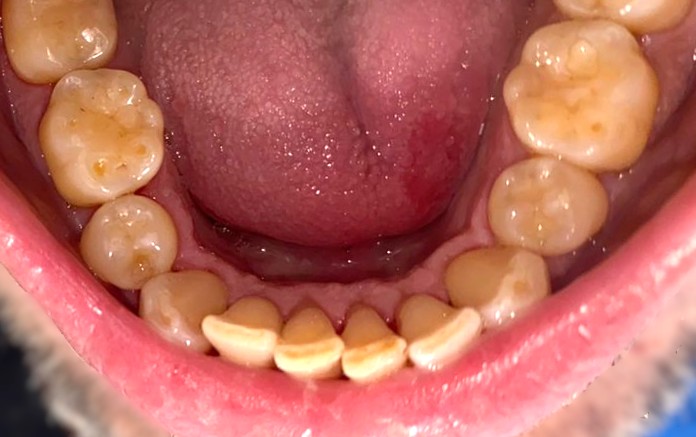 Limpieza dental — Después